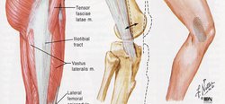 ITB-Syndrome-Hip Bursitits